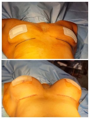 Breast-Augmentation