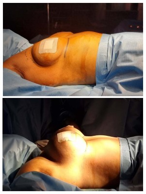 Breast-Augmentation1