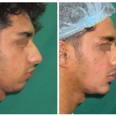 Chin-implant-augmentation