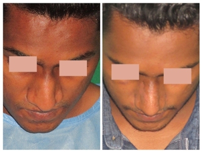Rhinoplasty