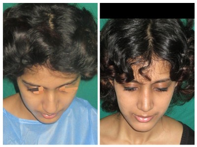 Rhinoplasty1