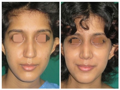 Rhinoplasty2