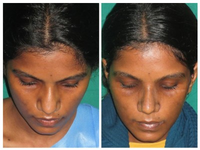 Rhinoplasty3