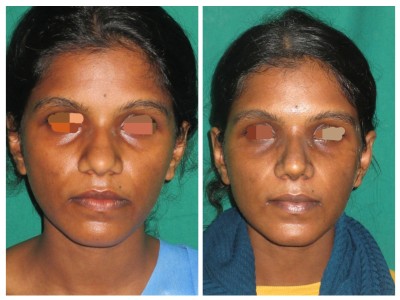 Rhinoplasty4