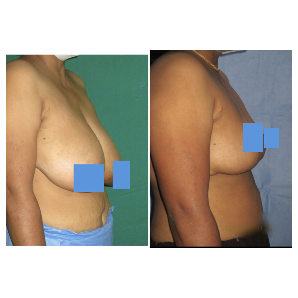Breast Reduction and Augmentation Surgery