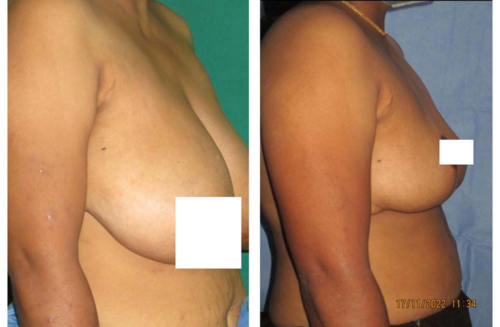 breast reduction surgery