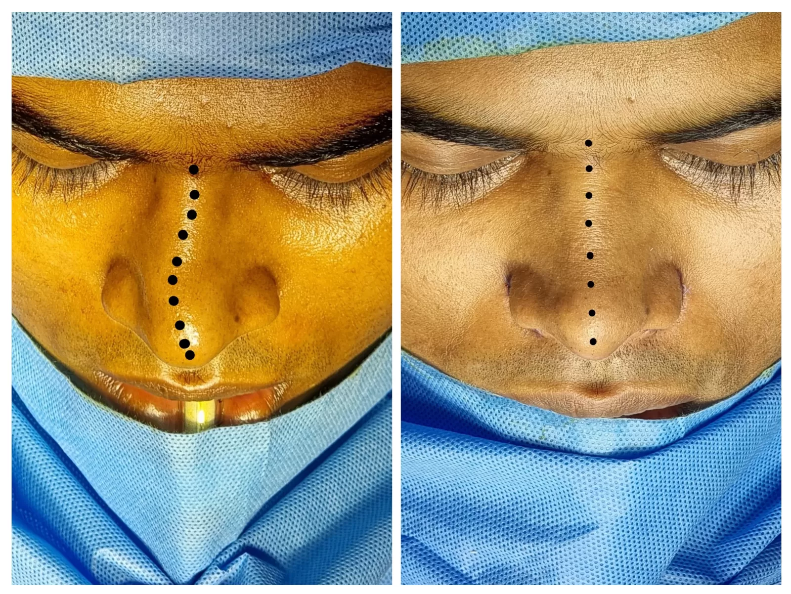 Best Rhinoplasty Surgeon in Kerala