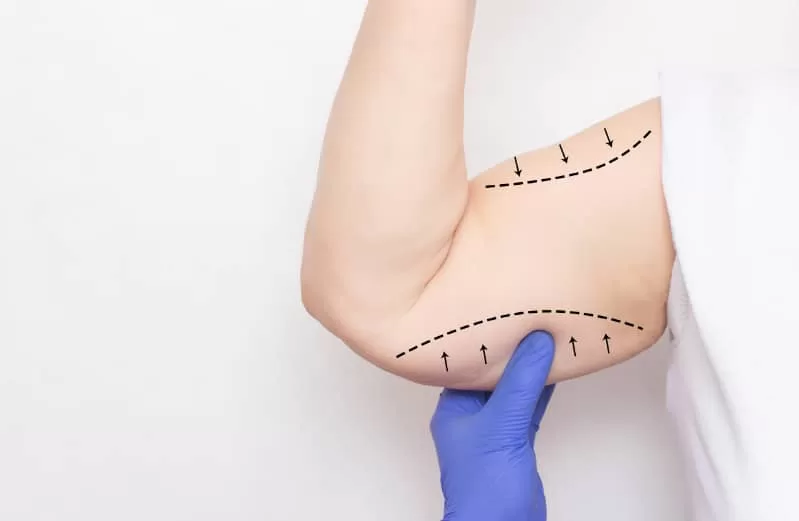 ARM SURGERY