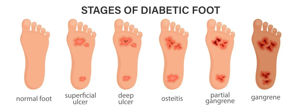 Diabetic Foot Reconstruction Surgery in Kerala
