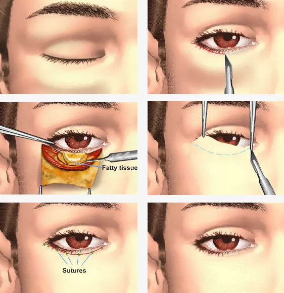Blepharoplasty-surgery_kerala