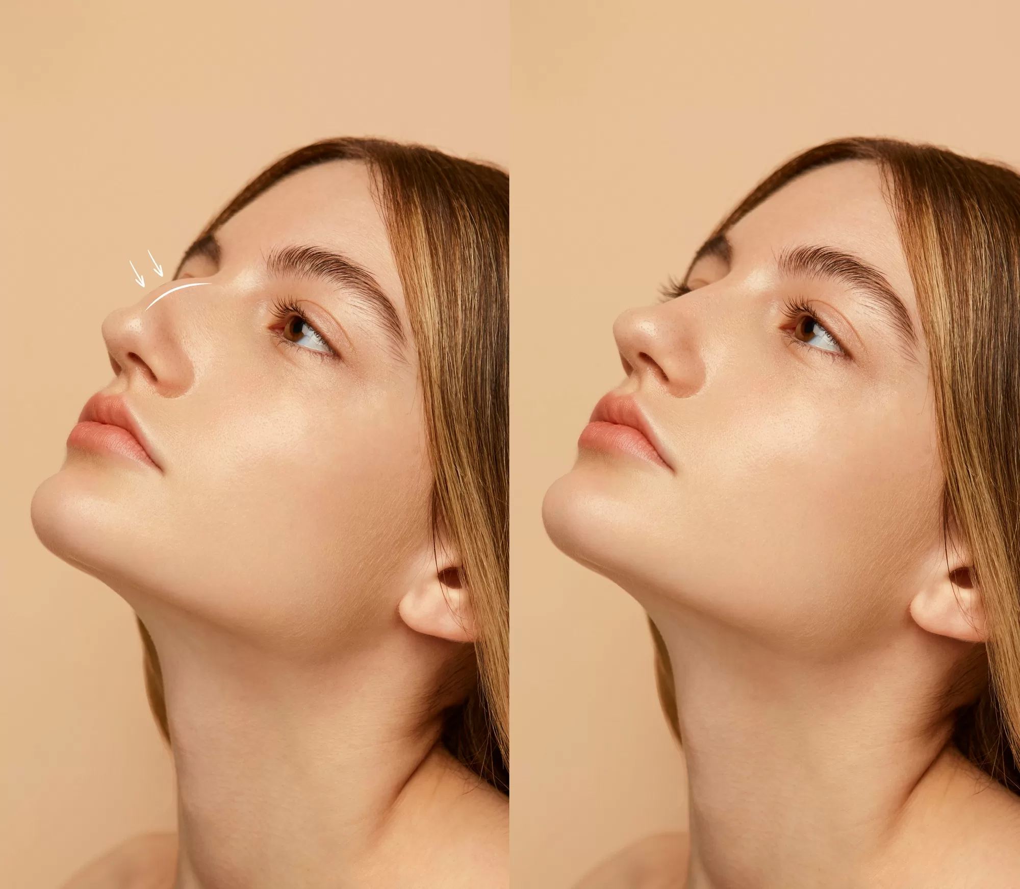 liquid rhinoplasty in india