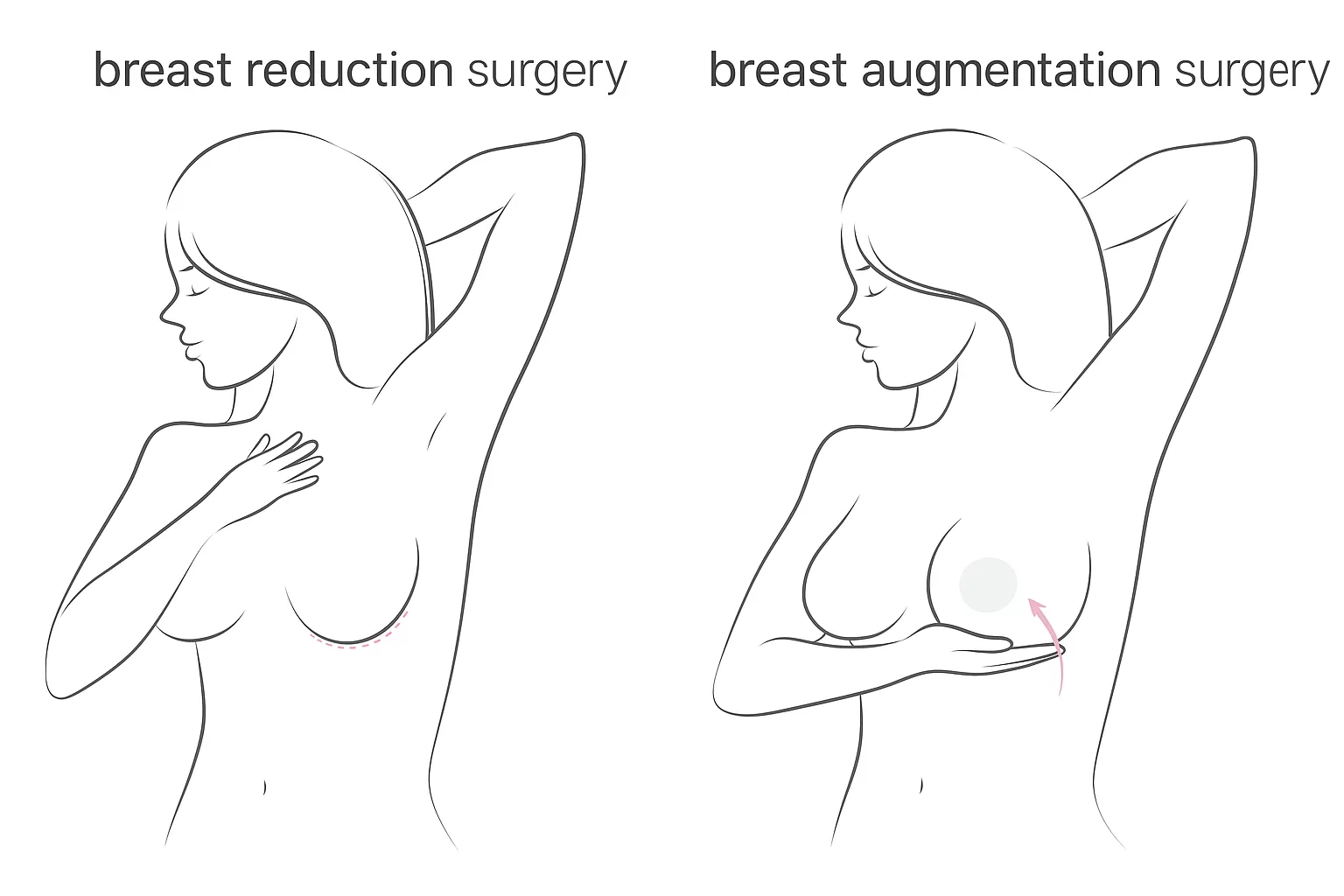Breast Reduction and Augmentation Surgery in Thrissur