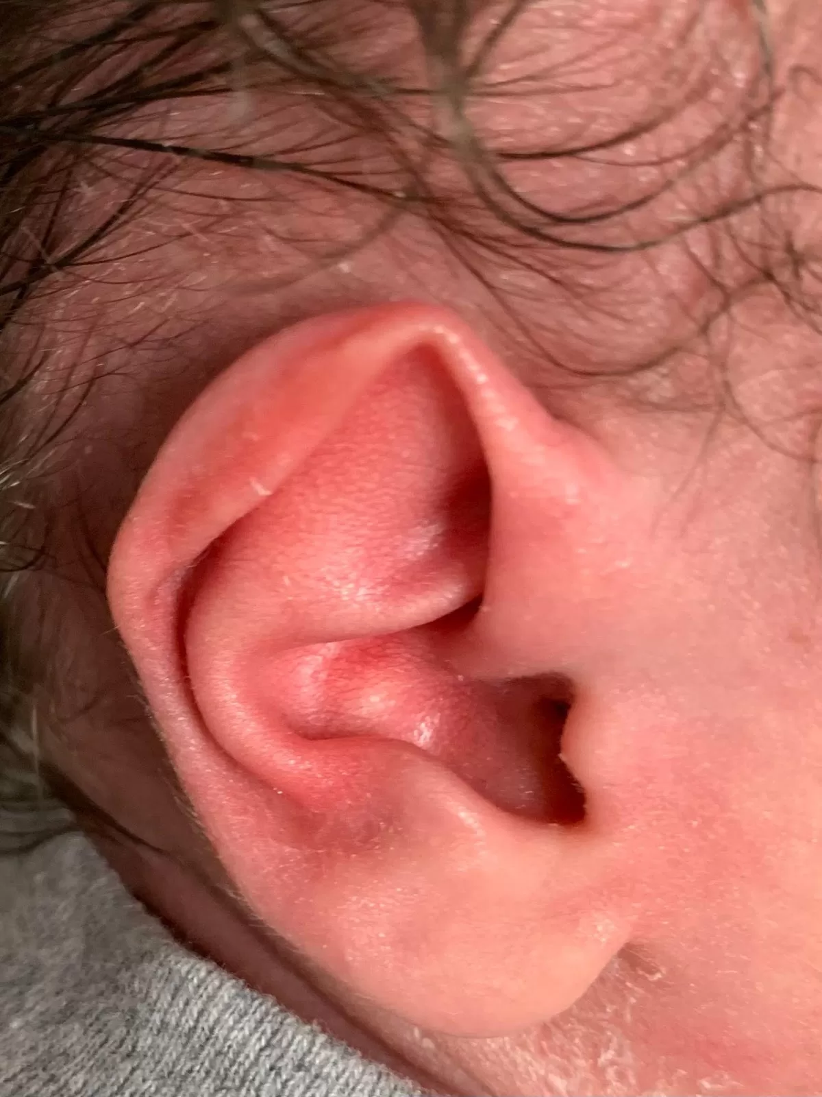 Ear-Abnormalities