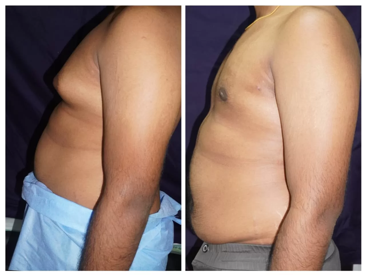 Gynecomastia surgery in june