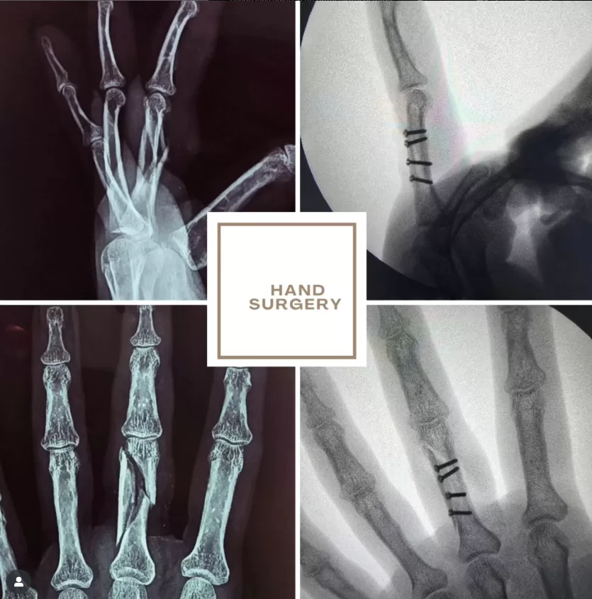 hand surgery in kerala