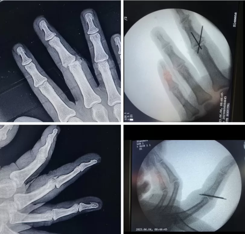 hand surgery in kerala