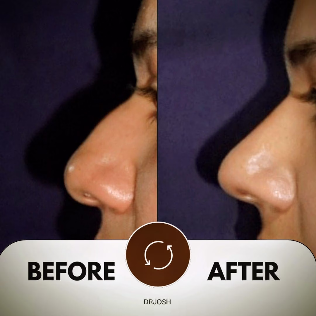female rhinoplasty