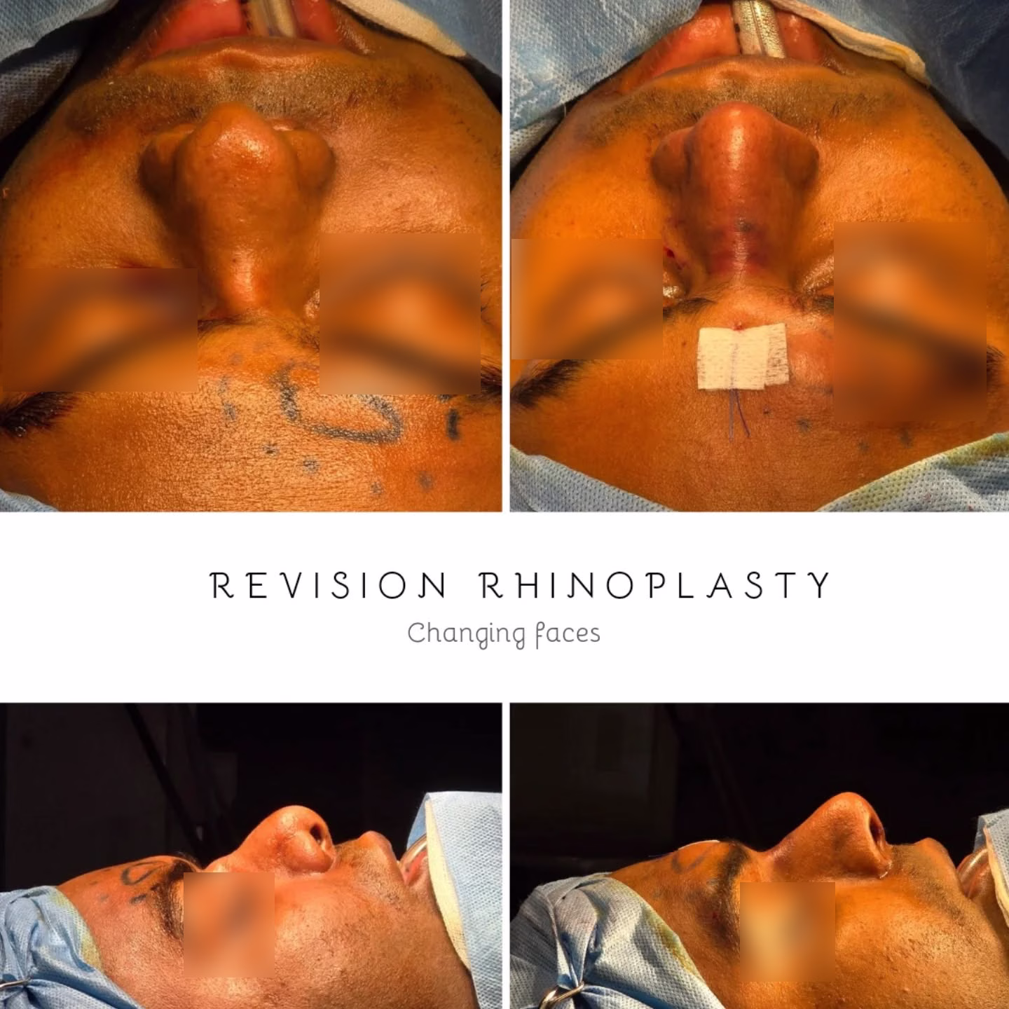 Male Rhinoplasty
