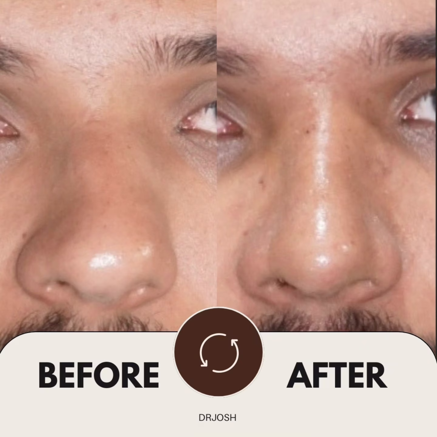 Male Rhinoplasty