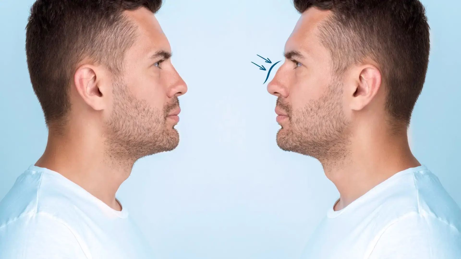 Rhinoplasty-in-Men