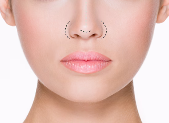 rhinoplasty