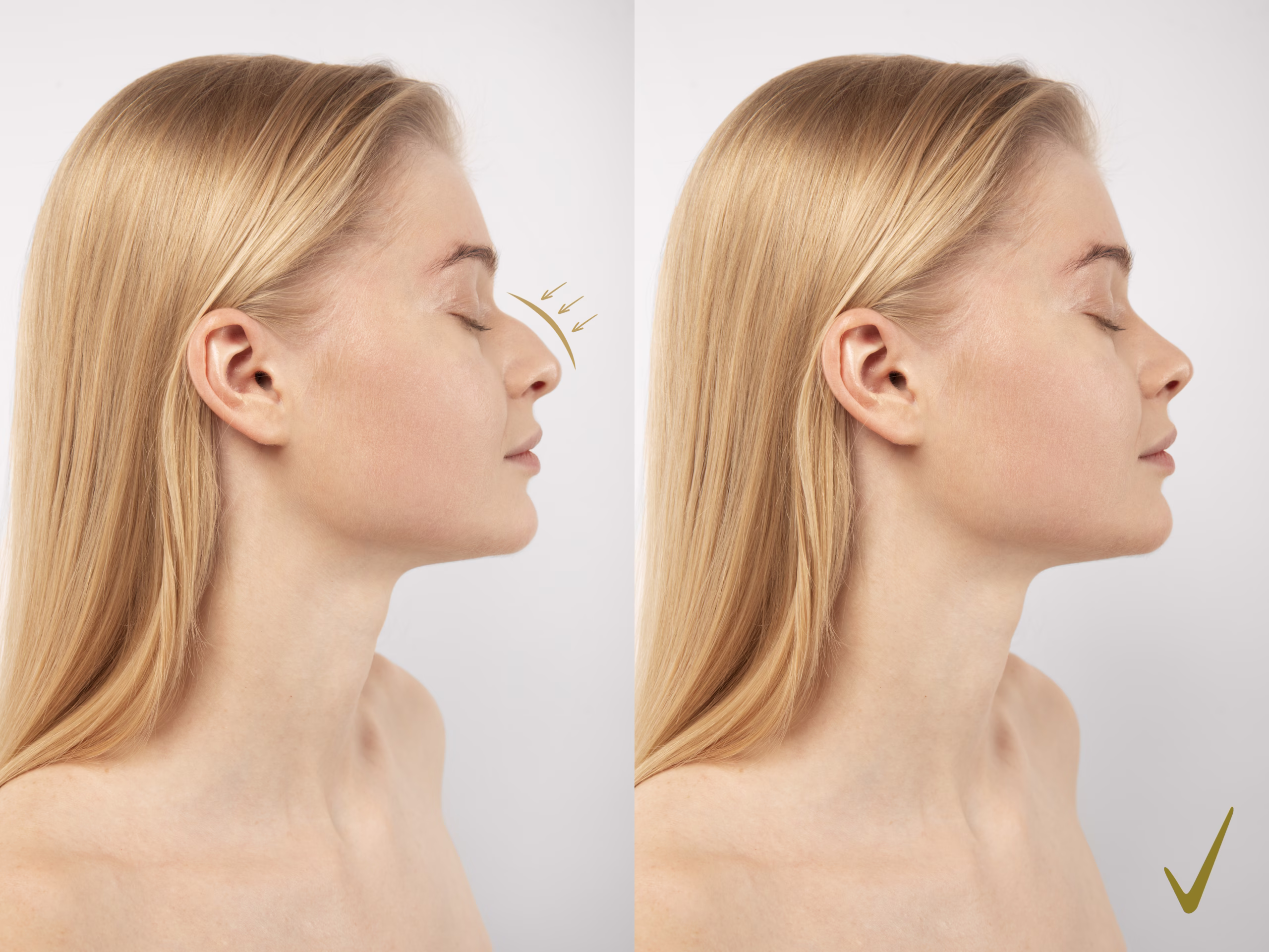 Augmentation Rhinoplasty