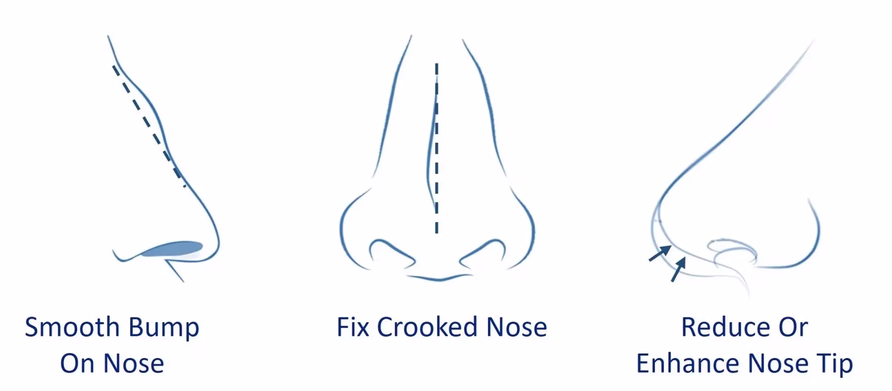 How-to-fix-crooked-nose-with-Rhinoplasty