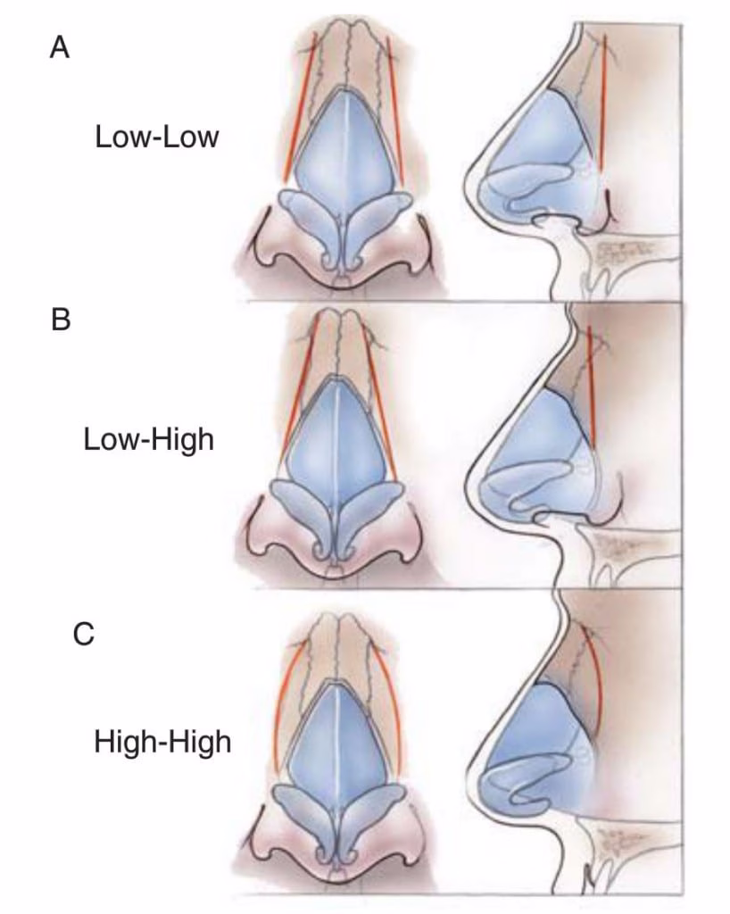 crooked-nose-osteotomies-818x1024