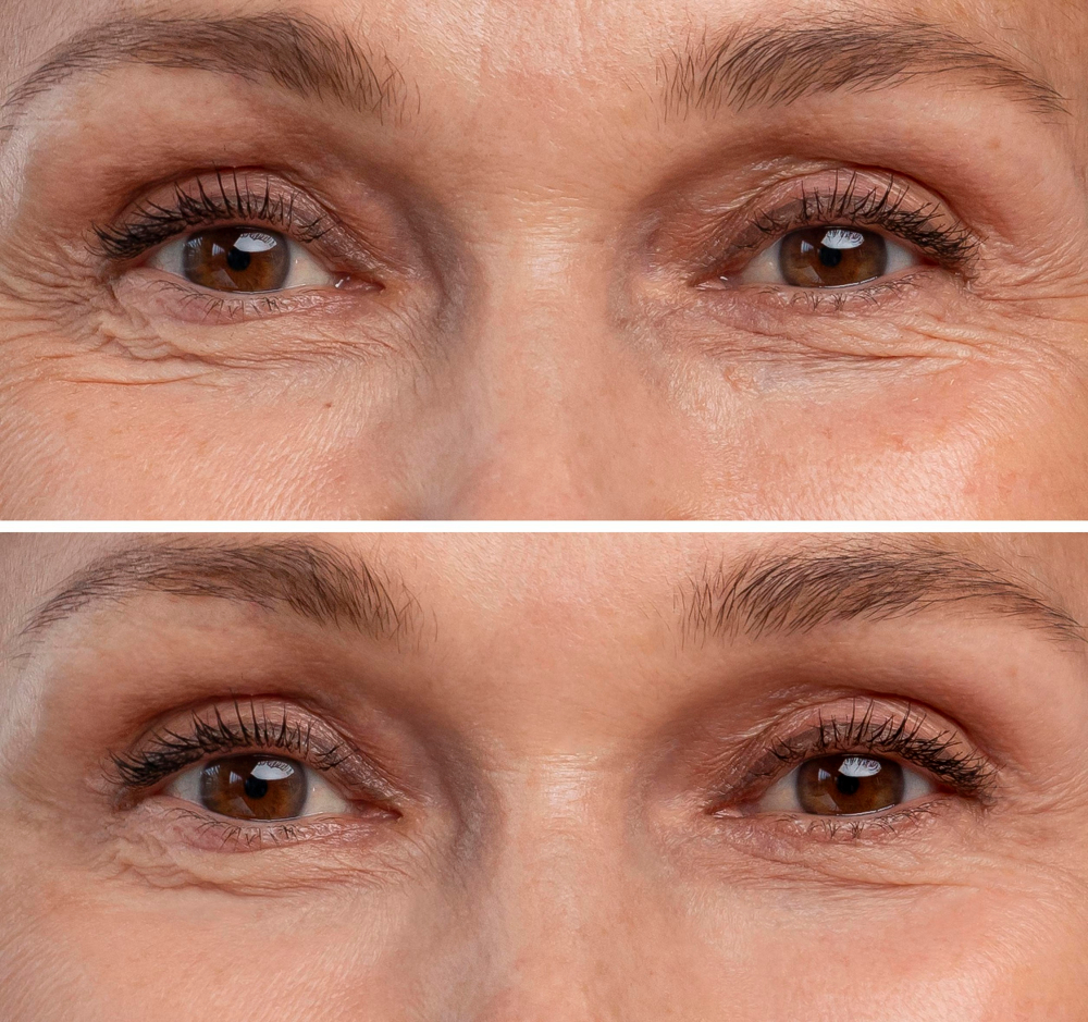 Lower Blepharoplasty